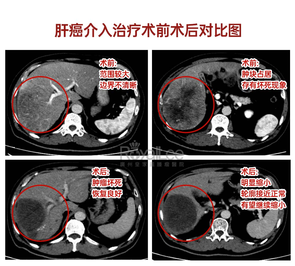 Before and After Surgery Before and After Surgery